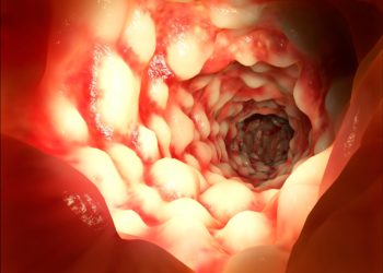 Bei chronisch entzündlichen Darmerkrankungen wie Morbus Crohn sind infolge der Gewebeschädigung mitunter Blutbeimengungen  im Stuhl und Blut am After festzustellen (Bild: Juan Gärtner/fotolia.com)
