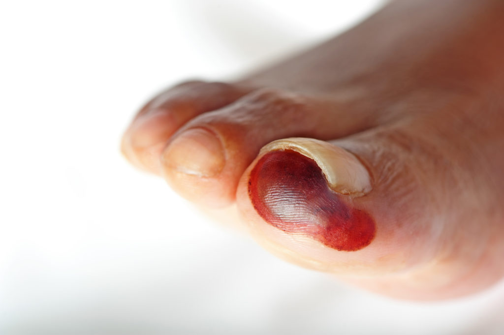 Oft werden Verletzungen an den Füßen bei Diabetes längere Zeit nicht bemerkt und es kann ein diabetisches Fußsyndrom entstehen. (Bild: HBK/fotolia.com)