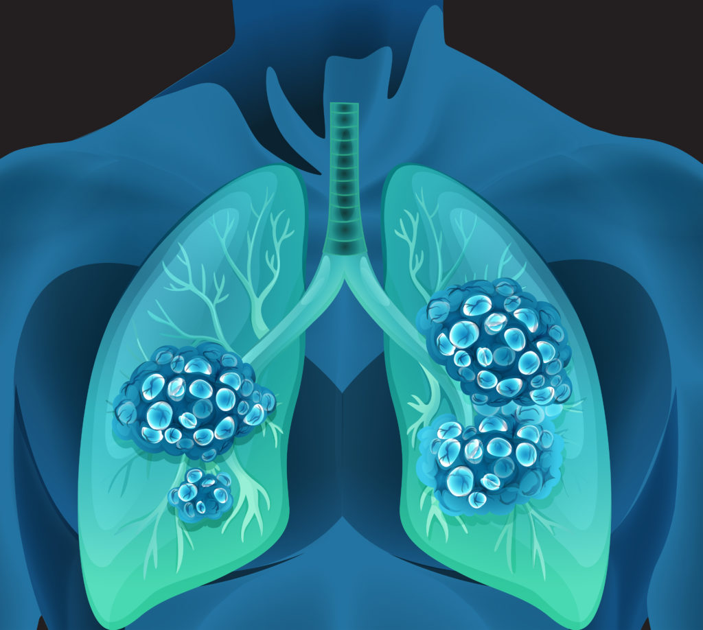 Kleinzellige Lungenkarzinome bilden häufig eine Resistenz gegen Chemotherapeutika. Wissenschaftler haben nun die Ursache hierfür indentifiziert. (BIld: blueringmedia/fotolia.com)