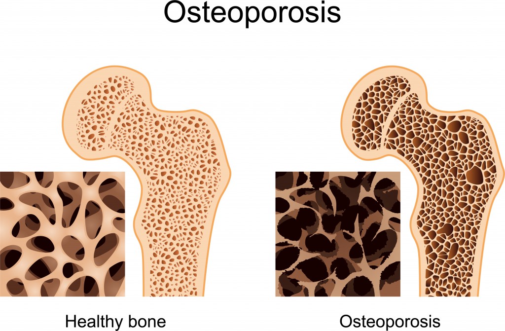 Schaubild mit Darstellungen von Knochen mit und ohne Osteoporose