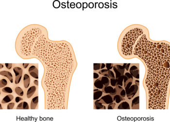 Schaubild mit Darstellungen von Knochen mit und ohne Osteoporose