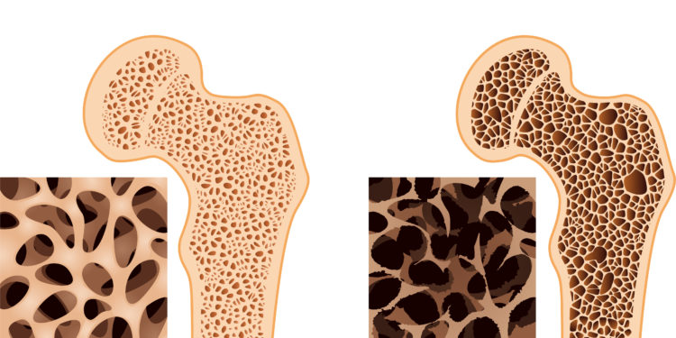 Schaubild mit Darstellungen von Knochen mit und ohne Osteoporose