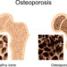 Schaubild mit Darstellungen von Knochen mit und ohne Osteoporose
