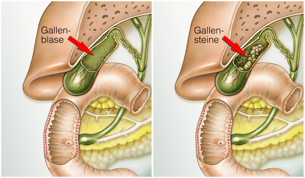 Oft sind Gallensteine in der Gallenblase für heftige Schmerzen verantwortlich. Bild: Henrie - fotolia