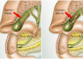 Oft sind Gallensteine in der Gallenblase für heftige Schmerzen verantwortlich. (Bild: Henrie/stock.adobe.com)