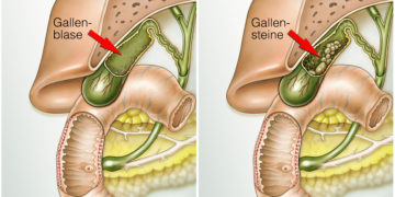 Oft sind Gallensteine in der Gallenblase für heftige Schmerzen verantwortlich. (Bild: Henrie/stock.adobe.com)