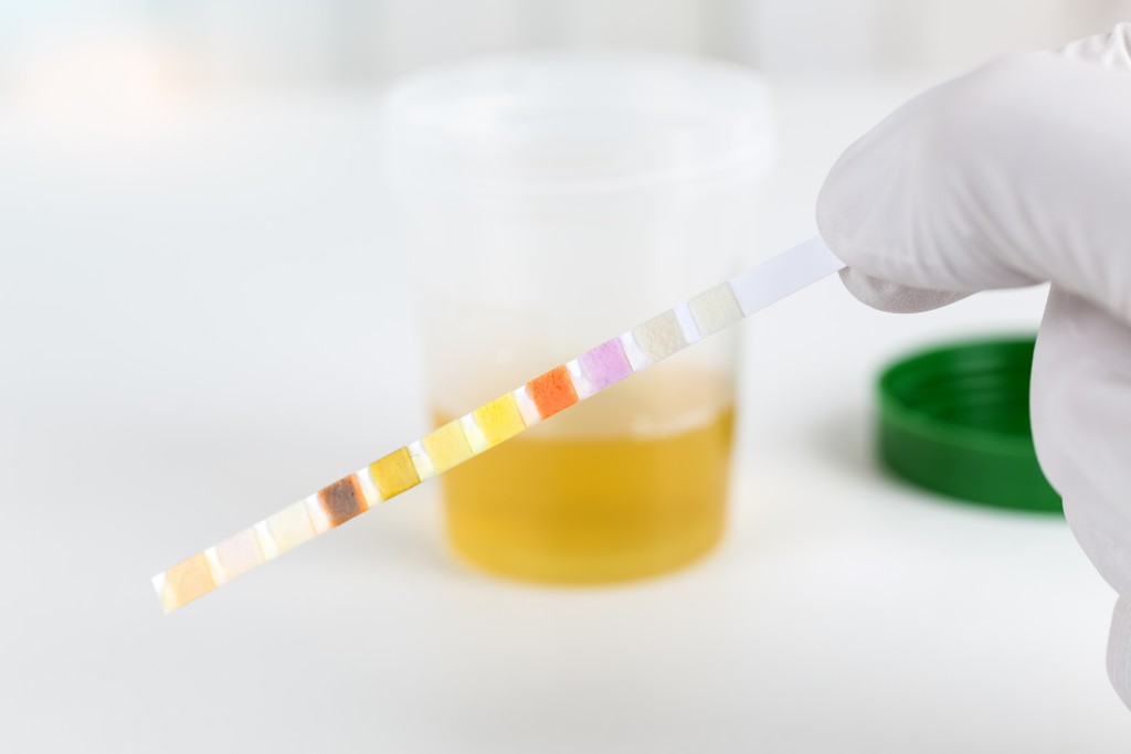 Betroffene fälschen Urinproben, um Krankheiten vorzutäuschen. Bild: tunedin - fotolia