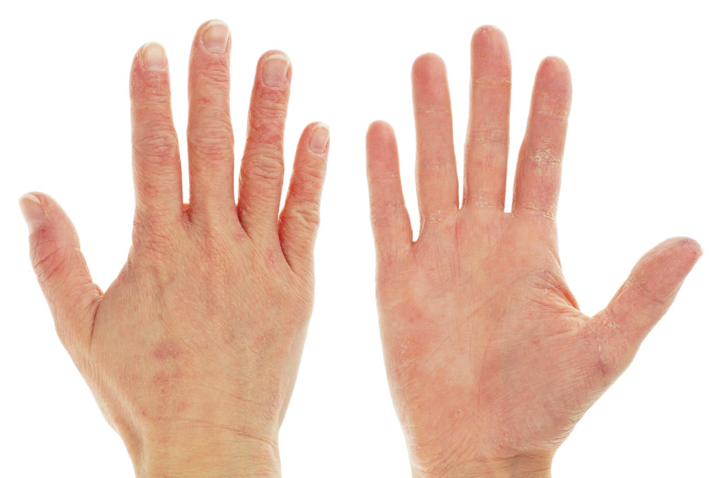 Hand der flecken auf Hautrötungen: Ursachen,