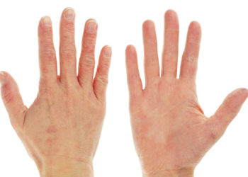 Rote Flecken und schuppige Haut auf der Hand können Hinweise auf ein Kontaktekzem sein. Experten raten dann zu einem frühen Arztbesuch. (Bild: Andy Lidstone/fotolia.com)