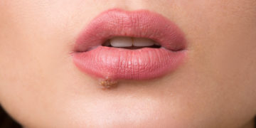 Bei einer Herpes-Infektion können verschiedene Hausmittel Linderung bewirken und zur Heilung beitragen. (Bild: kopitinphoto/fotolia.com)