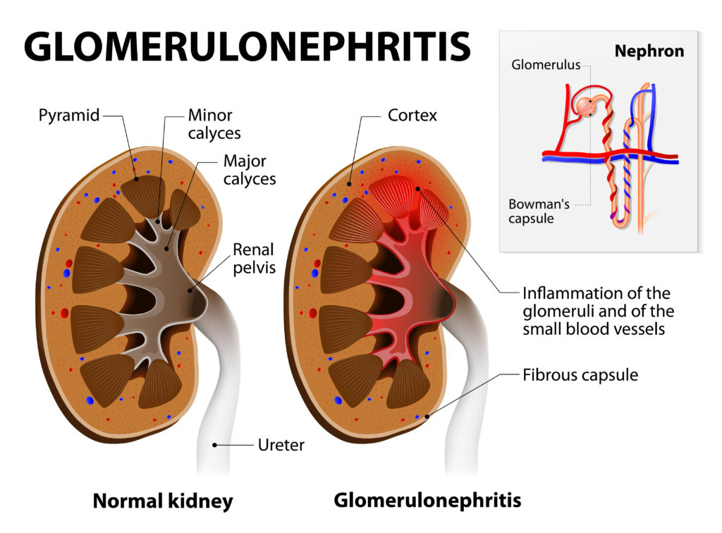 Viele Krebspatienten entwickeln eine begleitende schwere Nierenerkrankung in Form der membranösen Glomerulonephritis. Die Ursache sind bestimmte Eiweißmoleküle, die von Tumoren gebildet werden. (Bild: designua/fotolia.com)
