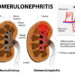 Viele Krebspatienten entwickeln eine begleitende schwere Nierenerkrankung in Form der membranösen Glomerulonephritis. Die Ursache sind bestimmte Eiweißmoleküle, die von Tumoren gebildet werden. (Bild: designua/fotolia.com)