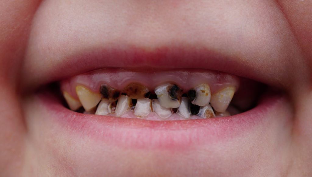 Meist sind Verfärbungen der Zähne bei Kindern durch Karies bedingt, doch kann sich auch eine Molare-Inzisive-Hypomineralisation verfärbte und poröse Zähne bedingen. (Bild: Trezvuy/fotolia.com)