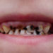 Meist sind Verfärbungen der Zähne bei Kindern durch Karies bedingt, doch kann sich auch eine Molare-Inzisive-Hypomineralisation verfärbte und poröse Zähne bedingen. (Bild: Trezvuy/fotolia.com)