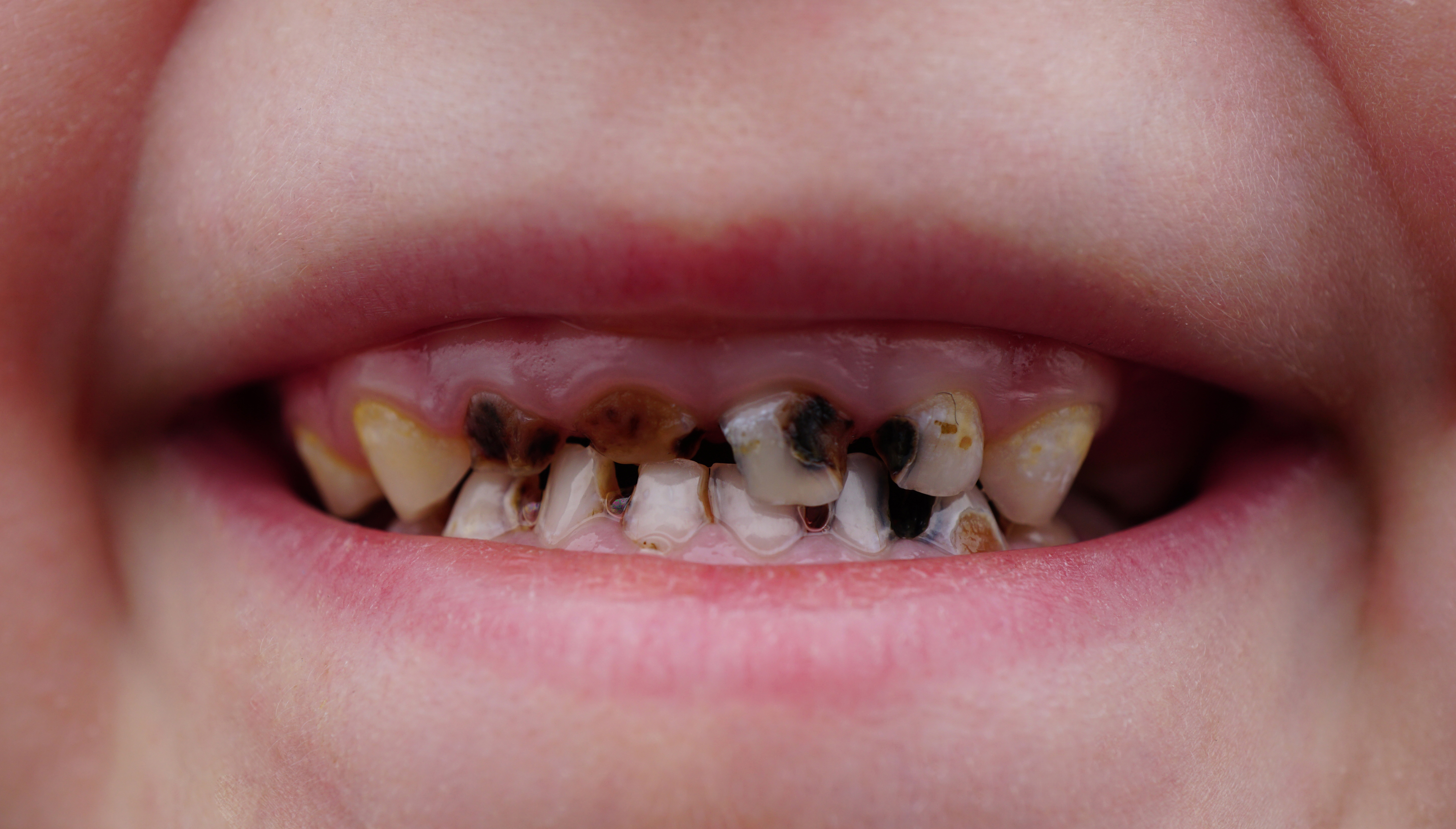 Ärzte Verfärbte und bröckelnde Kinderzähne müssen kein Karies sein Heilpraxis