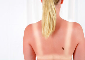 Starke Sonneneinstrahlung auf unserer Haut kann zu Krebs führen. Viele Menschen schützen sich ungenügend vor der Sonne, obwohl ausreichender Sonnenschutz sie vor Krebs schützen würde. Erstaunlicherweise schützen sie auch viele Menschen nicht richtig, die bereits vorher eine Hautkrebserkrankung erlitten hatten. (Bild: Dan Race/fotolia.com)