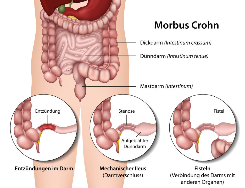 Morbus Crohn ist eine chronische Entzündung des Darms. 