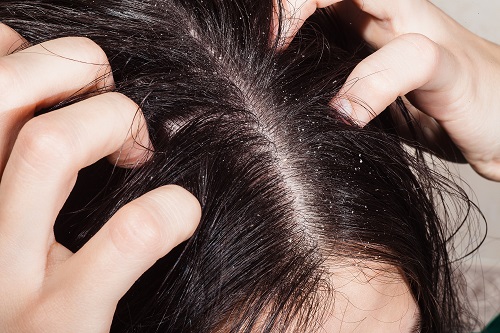 Bestimmte Bakterien auf der Kopfhaut könnten möglicherweise für eine starke Schuppenbildung verantwortlich sein. (Bild: artem_goncharov/fotolia.com) 