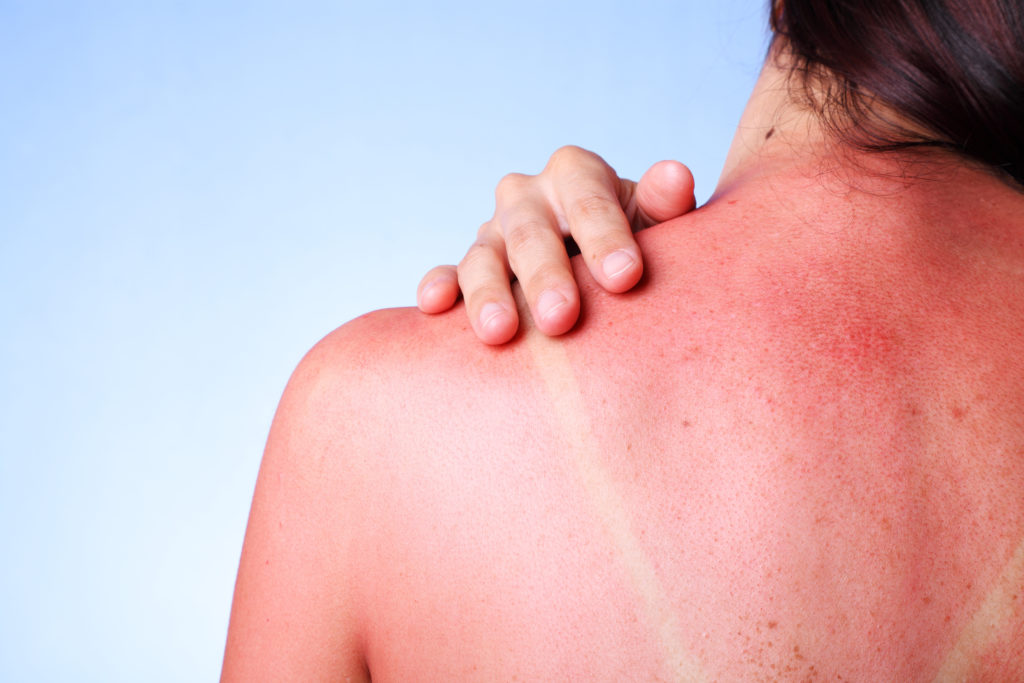 Auch die Frühlingssonne hat schon viel Kraft und verursacht schnell einen Sonnenbrand. Natürliche Hausmittel können hier Abhilfe schaffen. (Bild: jivimages/fotolia.com)