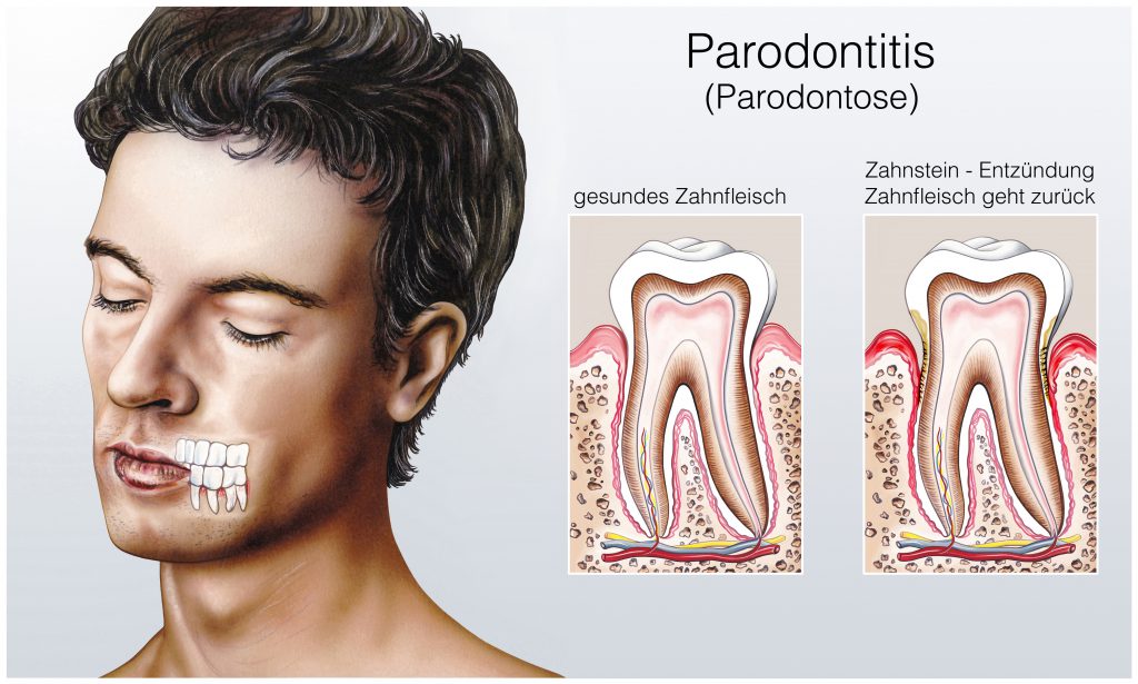 Bei einer Parodontitis ist der Zahnfleischrückgang irreversibel und es droht schlimmstenfalls der Zahnverlust. (Bild: Henrie/fotolia.com)