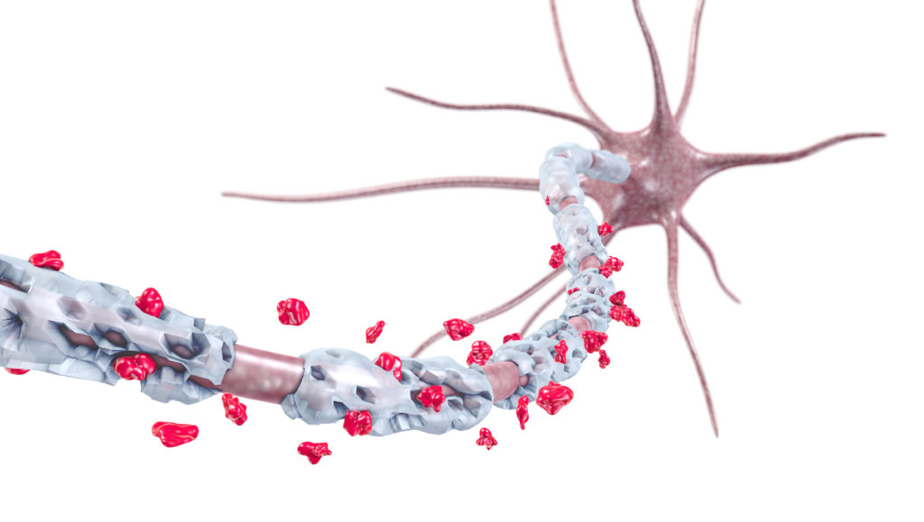 Die Zerstörung der Isolierschicht von Nervenzellen bei Multipler Sklerose kann mit einem Pflanzenwirkstoff möglicherweise gestoppt werden. (Bild: ag visuell/fotolia.com)