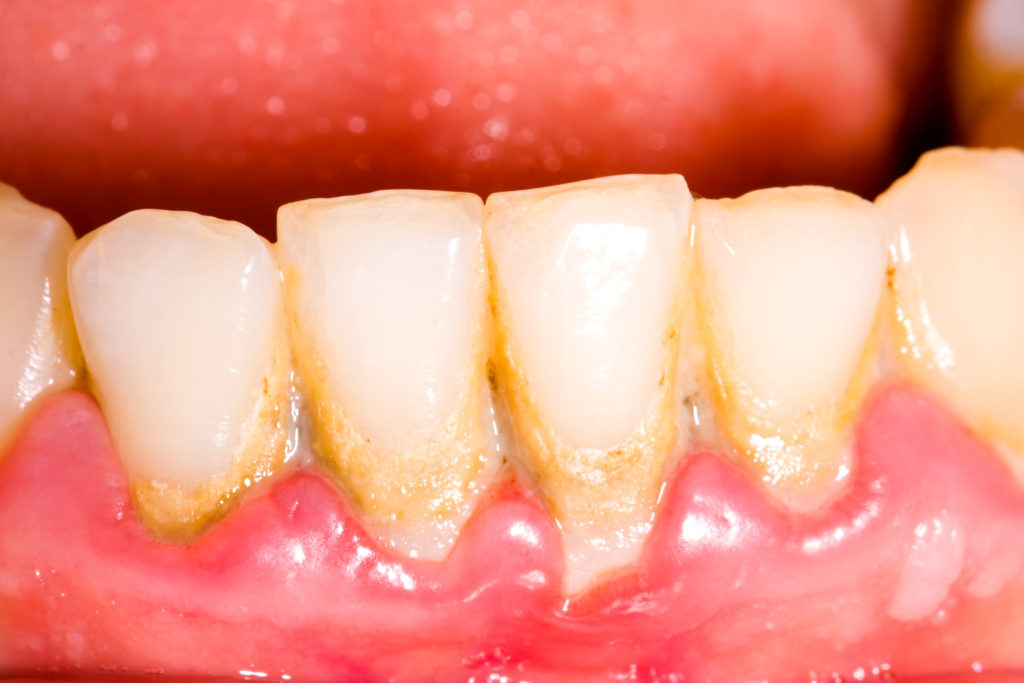 Bildet sich Plaque auf den Zähnen, ist das Risiko für einen Rückgang des Zahnfleischs deutlich erhöht. (Bild: Zsolt Bota Finna/fotolia.com)