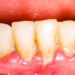 Immer mehr Menschen leiden an sogenannten "Kreidezähnen". Diese Zähne, auf denen oft weiß-gelbliche oder gelb-braune Bereiche zu sehen sind, sind sehr schmerzempfindlich und reagieren äußerst sensibel auf Hitze, Kälte und Zähneputzen. (Bild: Zsolt Bota Finna/fotolia.com)