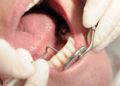 Ein Rückgang des Zahnfleischs kann die Stabilität des Zahnhalteapparats deutlich beeinträchtigen. (Bild: K.-U. Häßler/fotolia.com)