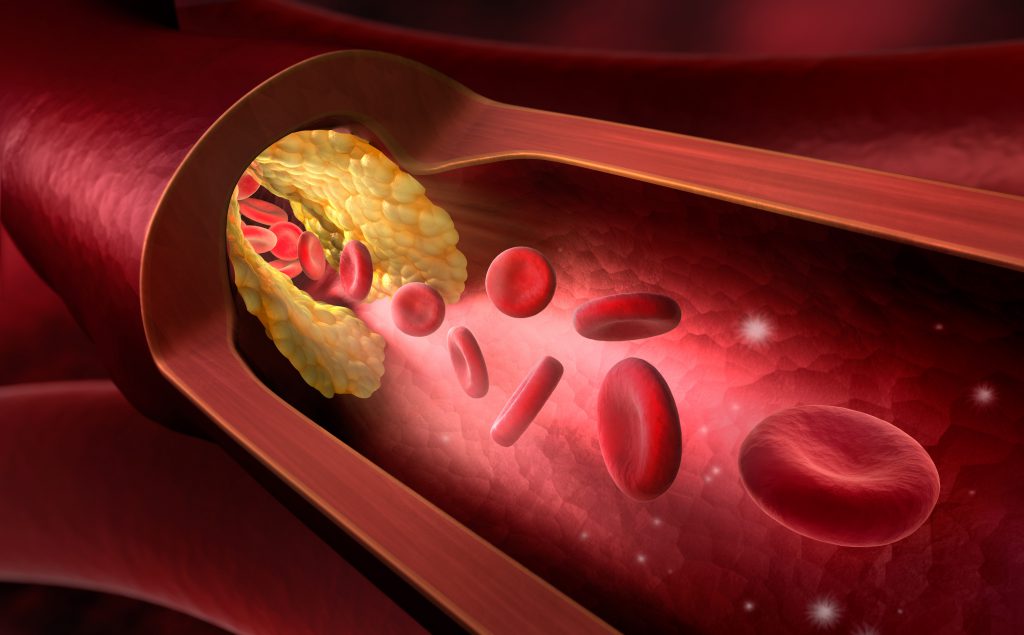 Ablagerungen in den Arterien durch Mangel an Bewegung. Bild: psdesign1 - fotolia