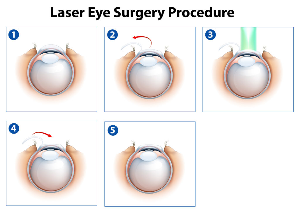 Lasik oder Linse? Bild: blueringmedia - fotolia