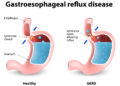 Reflux ist eine häufige Ursache für ständiges Aufstoßen. (Bild: designua/stock.adobe.com)