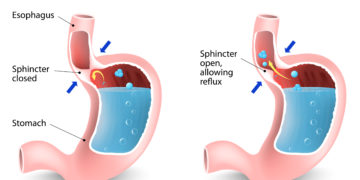 Reflux ist eine häufige Ursache für ständiges Aufstoßen. (Bild: designua/stock.adobe.com)