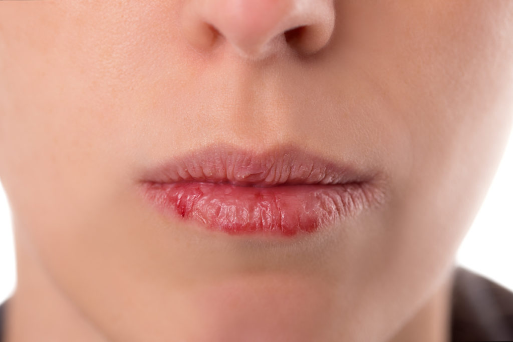 Begleitend können Symptome wie ein Kloßgefühl im Hals, Mundgeruch oder trockene, gesprungene Lippen auftreten. (Bild: Miriam Dörr/fotolia.com)