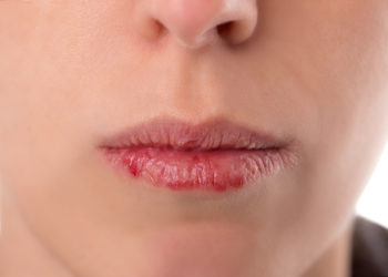 Begleitend können Symptome wie ein Kloßgefühl im Hals, Mundgeruch oder trockene, gesprungene Lippen auftreten. (Bild: Miriam Dörr/fotolia.com)