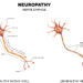 Chronische Schmerzen in Form einer Neuropathie können mit Hilfe der rückenmarksnahen Elektrostimulation therapiert werden. (Bild: reineg/fotolia.com)
