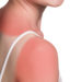 Sonnenverbrannte Haut ist keine Lappalie. Denn jeder einzelne Sonnenbrand wird auf unserem Haut-Konto gespeichert. (Bild: llhedgehogll/fotolia.com)