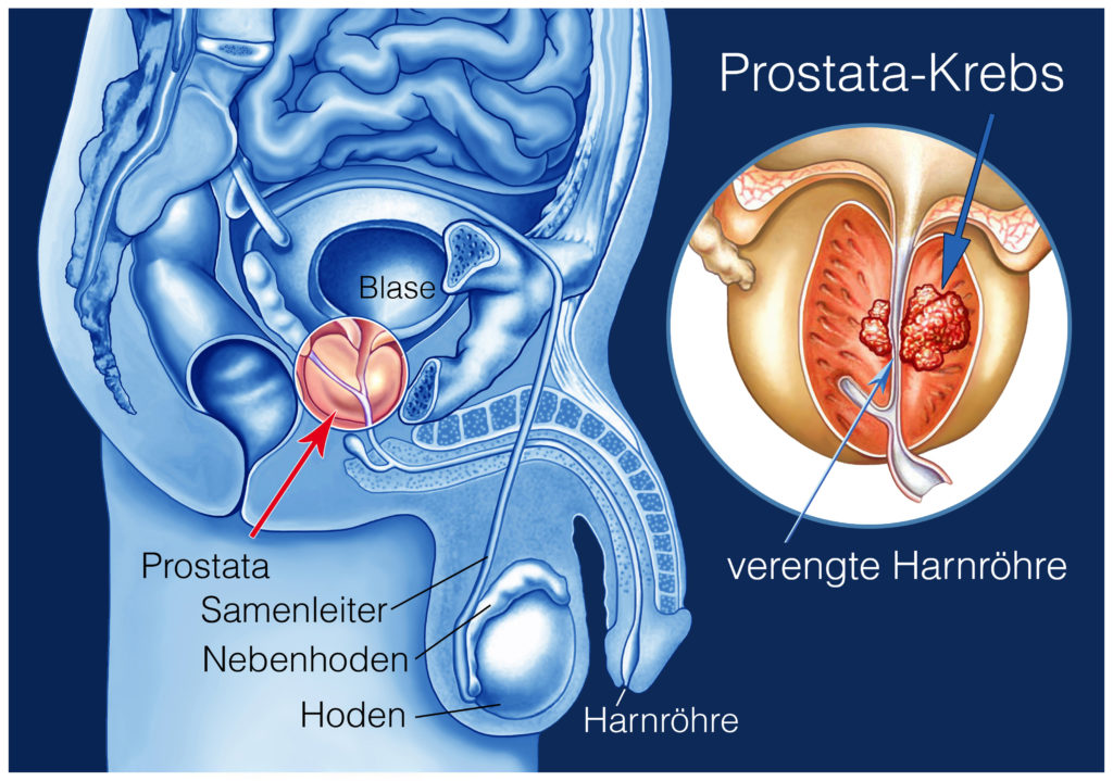 Prostatakrebs ist eine Erkrankung, die viele Männer weltweit das Leben kostet. Ein simpler Test und eine neue Art der Behandlung könnten helfen, dass einige dieser Todesfälle verhindert werden. (Bild: Henrie/fotolia.com)