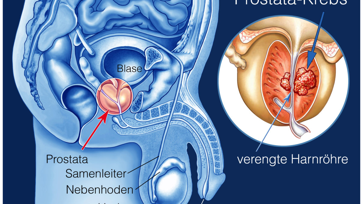 prostata drückt Ki gyakrabban beteg prosztata rák
