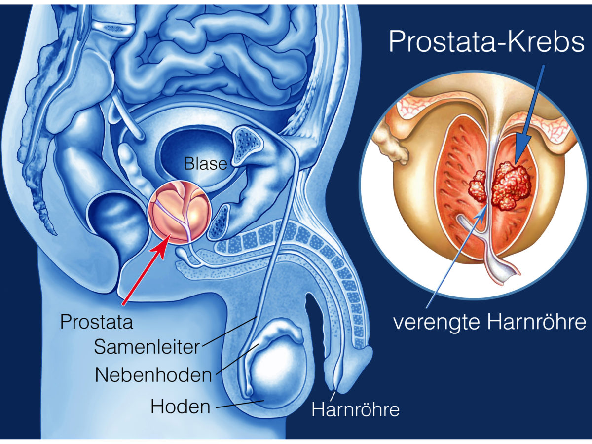 prostata drückt
