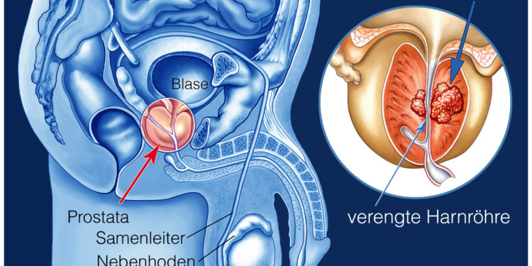 infectii urinare tratamentul prostatitei dmitry dibrov