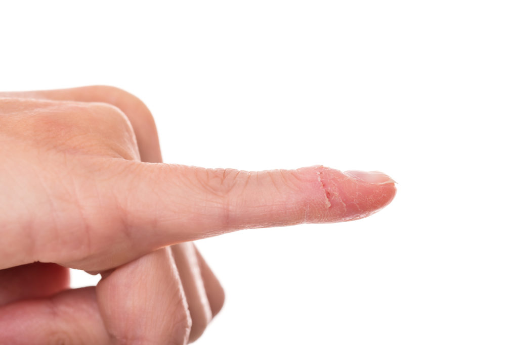 Ein Finger mit Nagelbettentzündung