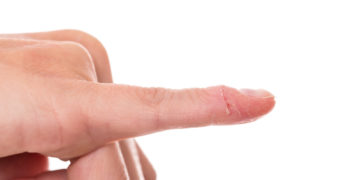 Eine Nagelbettentzündung ist meist äußerst schmerzhaft, lässt sich jedoch mit verschiedenen Hausmitteln relativ gut behandeln. (Bild: Miriam Dörr/stock.adobe.com)