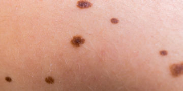 Pigmentflecken können sehr unterschiedliche Formen annehmen und sind meist unbedenklich. Allerdings können sie auch im Zusammenhang mit ernsten Erkrankungen stehen. (Bild: animaflora/fotolia.com)