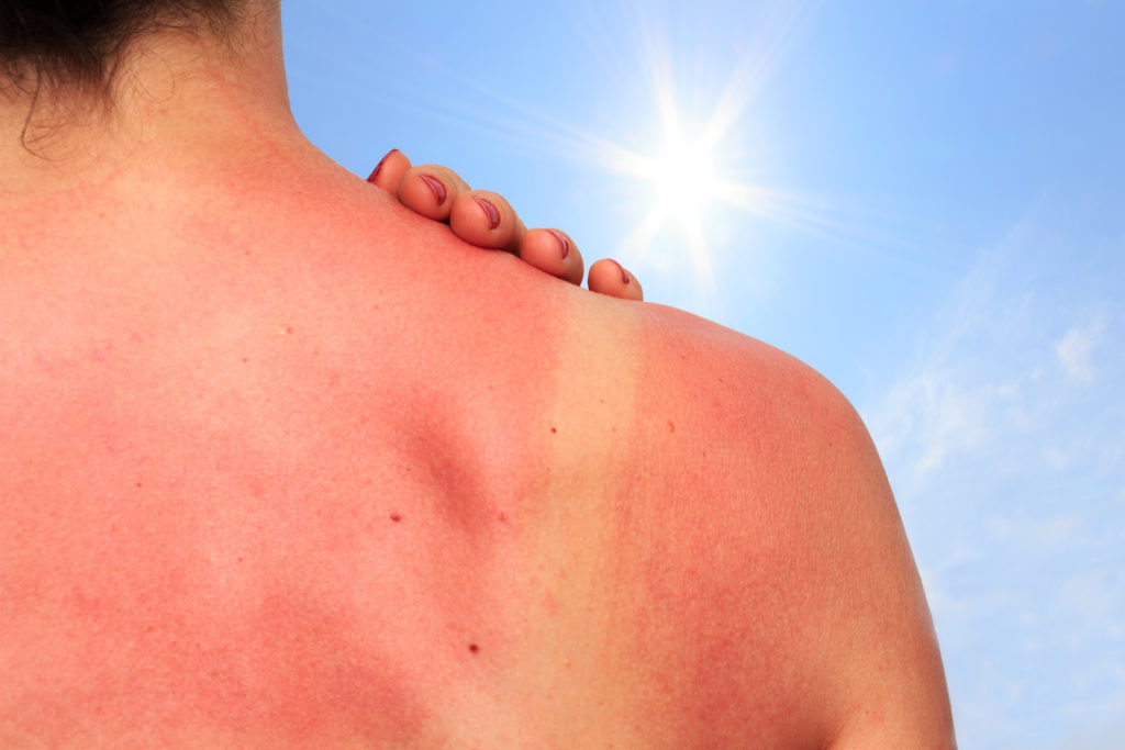Wer unerwartet einen Sonnenbrand oder andere unangenehme Hautrötungen bekommt, sollte einen Blick auf seine Medikamentenliste werfen. Die Einnahme von einigen Präparaten kann zu Hautreaktionen führen. (Bild: juefraphoto/fotolia.com)
