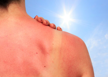 Hautkrebs ist die häufigste Krebserkrankung in Deutschland. Jeder Sonnenbrand erhöht das Erkrankungsrisiko. (Bild: juefraphoto/fotolia.com)