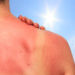 Hautkrebs ist die häufigste Krebserkrankung in Deutschland. Jeder Sonnenbrand erhöht das Erkrankungsrisiko. (Bild: juefraphoto/fotolia.com)