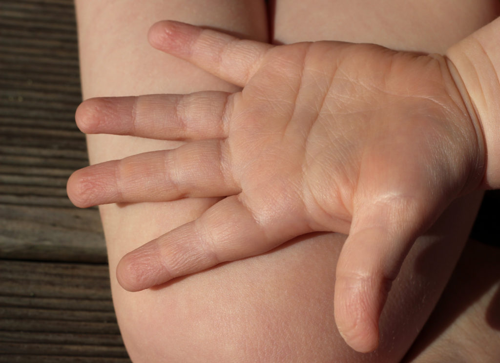 Kinder kommen nach dem Spielen im Freien schon mal mit einem Holzsplitter in der Haut nach Hause. Bevor so ein Schiefer entfernt wird, sollte die Wunde unbedingt gereinigt werden. (Bild: D. Starmann/fotolia.com)