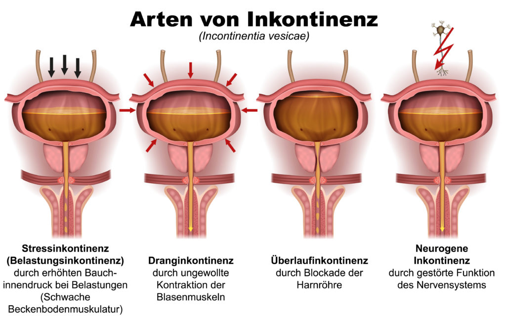 Verschiedene Auslöser für Inkontinenz. Bild: bilderzwerg - fotolia