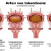 Verschiedene Auslöser für Inkontinenz. Bild: bilderzwerg - fotolia