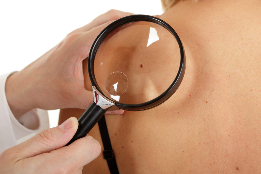 Bei Hautkrebs ist vor allem die frühzeitige Erkennung wichtig.  (Bild: fovito/fotolia.com) 